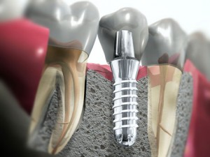 Straumann Dental Implant System