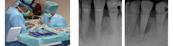 Tratamiento quirúrgico de la periodontitis Tratamiento quirúrgico de la periodontitis