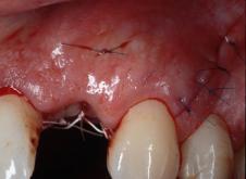 Microcirugía periodontal Microcirugía periodontal