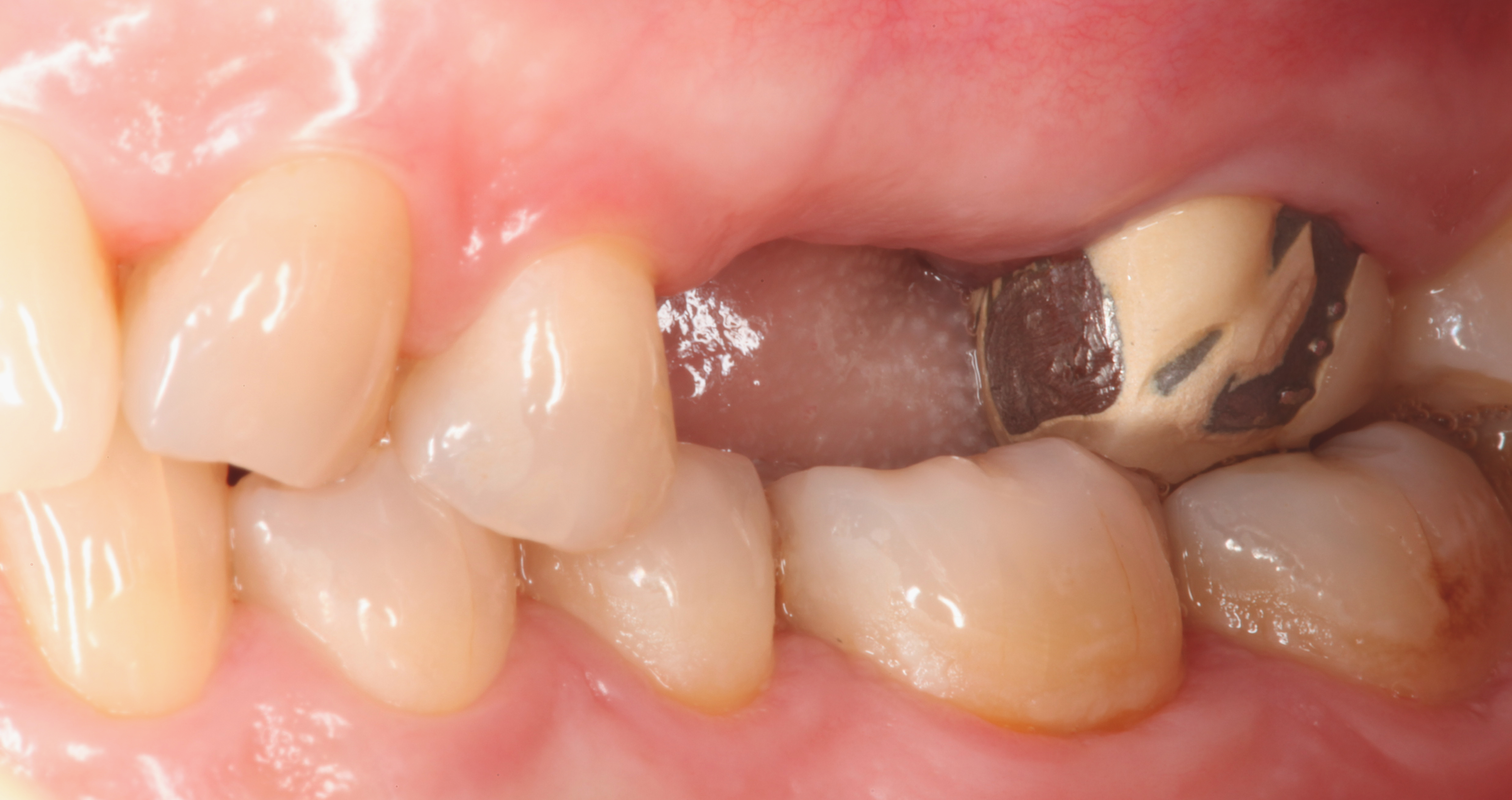 MA_inicial_MA